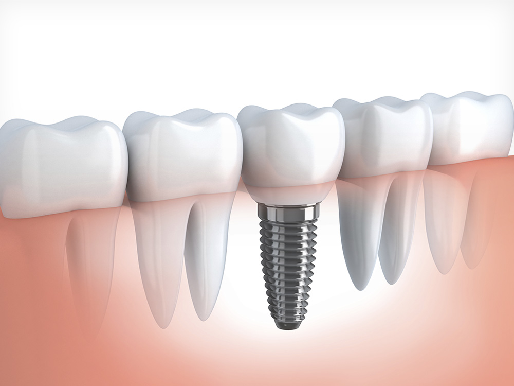 [:en]Implant[:]