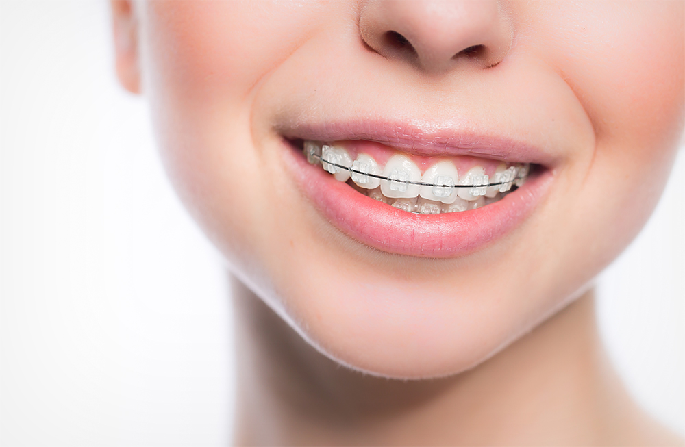 1 Braces Treatment in Singapore Damon, Metal & Ceramic Braces