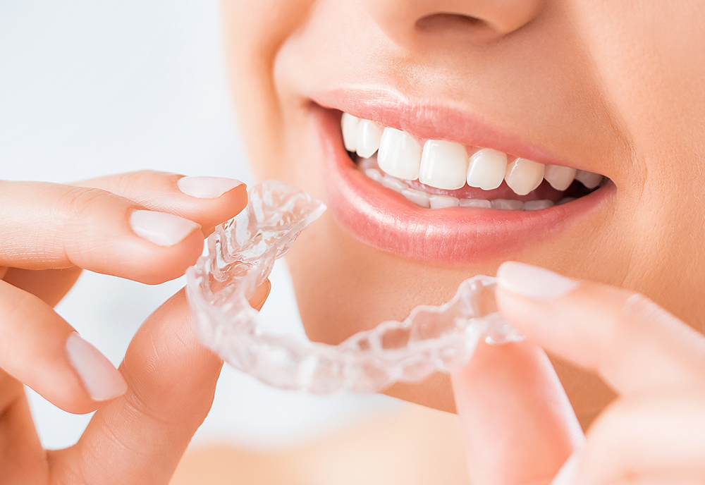 [:en]Invisalign[:]