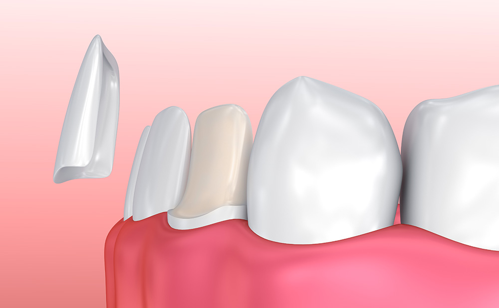 [:en]Veneers[:]