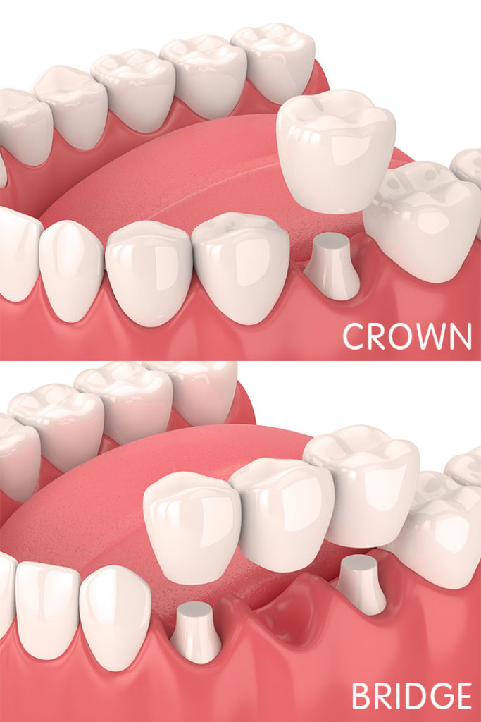 the anchoring of a crown bridge or