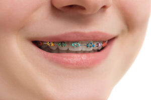 Braces Treatment Cost Singapore