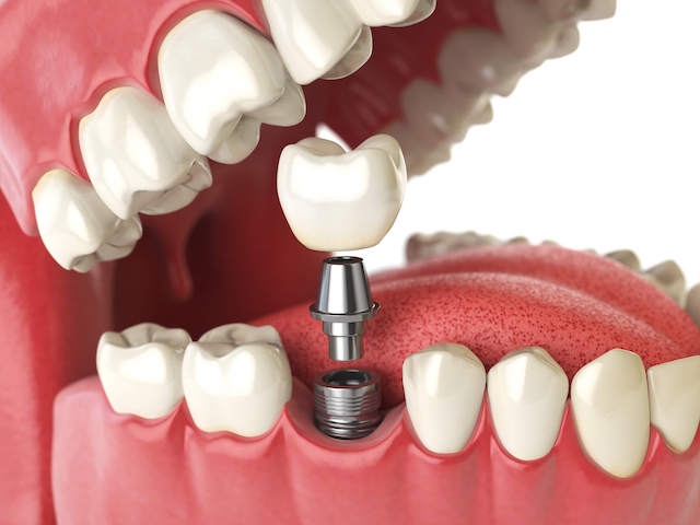 Dental Implant Price Singapore