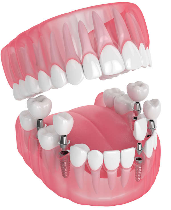 Dental Implants in Singapore | Tooth & Denture Implants Cost