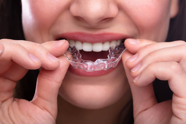 Invisalign Dental Treatment Singapore