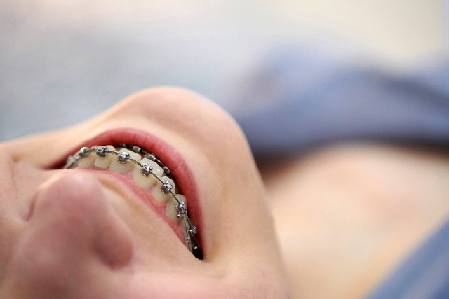 All About Damon Braces & How They Hold Up To Metal Braces